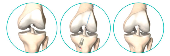Операция колено пкс. Разрыв связок коленного сустава ПКС операция. Пластика передней крестообразной связки (ПКС). Пластика связок коленного сустава операция. Имплант крестообразной связки коленного сустава.